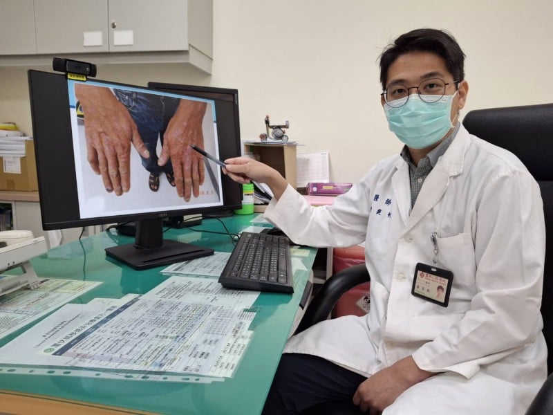 身上乾癬伴隨關節疼痛 可能是免疫系統敵我不分 嚴重要換關節